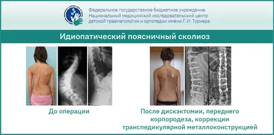 Не просто дефект, а болезнь: как распознать сколиоз и почему его  обязательно нужно лечить | 27.11.2023 | Ярославль - БезФормата