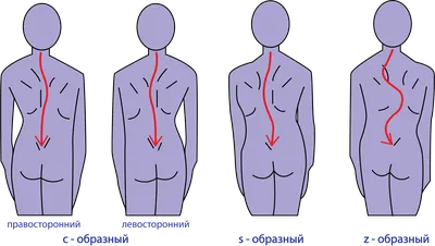 Правосторонний сколиоз - лечение, диагностика в Клинике Бакланова