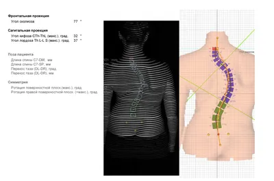 Профилактика и лечение сколиоза у ребёнка | Медицинский центр Доверие