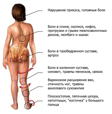 Сколиоз: этиология, классификация, диагностика, лечение - Vertebra