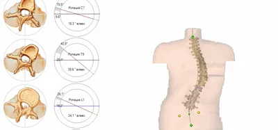 Сколиоз и искривления позвоночника | Статьи интернет-магазина ORTHOBOOM