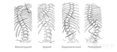 Левосторонний Сколиоз Левосколиоз Мышцы И Позвоночник Кривизна Позвоночника  При Сколиозе Инфографика Векторная Иллюстрация — стоковая векторная графика  и другие изображения на тему Анатомия - iStock