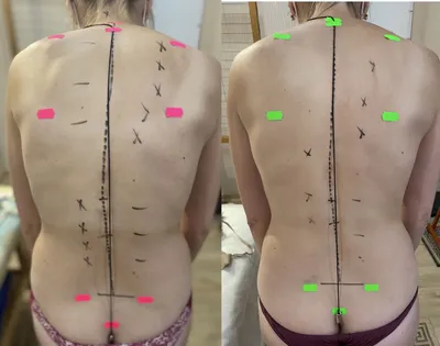 Сколиоз 3-4 стадия, можно ли обойтись без операции и корсетов. — Светлана  Самара на TenChat.ru