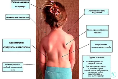 Сколиоз - лечение, симптомы, диагностика, причины, коррекция спины