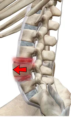 Спондилолистез (смещение позвонков)
