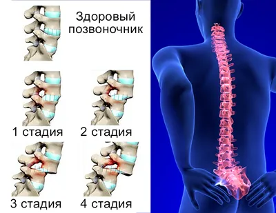 Смещение и нестабильность шейных позвонков - Первая Медицинская Клиника