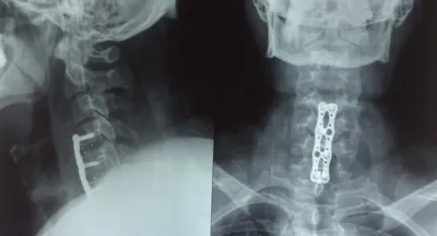 Изображение женщины с рентгеновской цервикального позвоночника и смещение  позвонков Osteochondrosis Стоковое Фото - изображение насчитывающей доктор,  зубоврачебно: 187757766