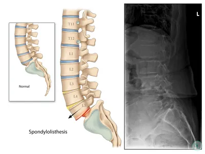 Смещение позвоночных дисков (спондилолистез), симптомы, как лечить