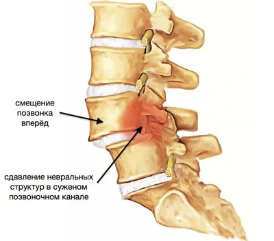 Деформация позвоночника (сколиотическая, кифотическая): симптомы,  диагностика, лечение искривления позвоночника, кифоза – Государственная  больница НКЦ №2 (ЦКБ РАН)