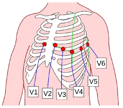 Наложение электродов при ЭКГ