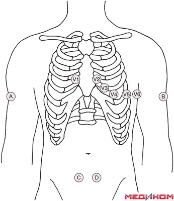 Спрей для ЭКГ Униспрей для снятия ЭКГ
