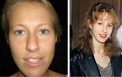 Собчак до и после операции фото фотографии