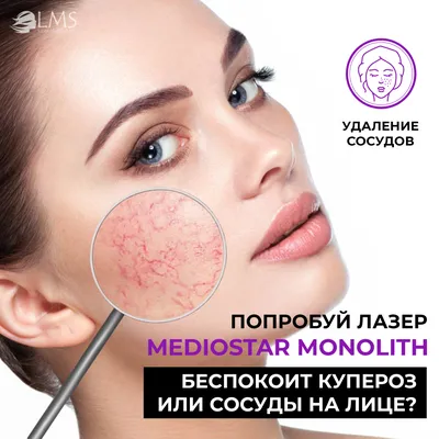 Лазерное удаление сосудов в Москве — Damas Medical Center