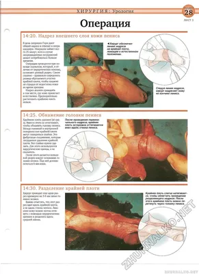 РАЗДЕЛ * Операция * ЛИСТ 3 * 14:25. Обнажение головки пениса * 14:30.  Разделение крайней плоти - Тело человека №17, страница 9