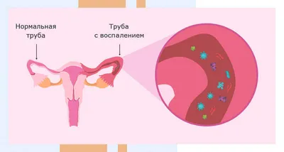 Обрезание крайней плоти