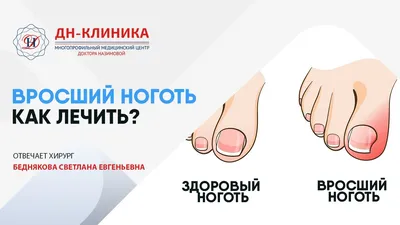 Лечение грибка ногтей | Центр «Dekamedical» в Москве