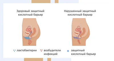 Удаление пупочной грыжи – «Dekamedical» Клиника в Москве.