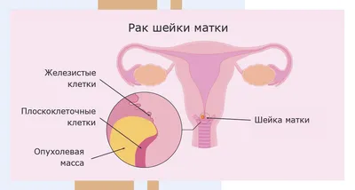 Двухэтапная коррекция гипоспадии с использованием свободного лоскута крайней  плоти – тема научной статьи по клинической медицине читайте бесплатно текст  научно-исследовательской работы в электронной библиотеке КиберЛенинка