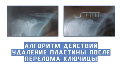 СПОСОБ СТАБИЛЬНОГО ОСТЕОСИНТЕЗА КЛЮЧИЦЫ