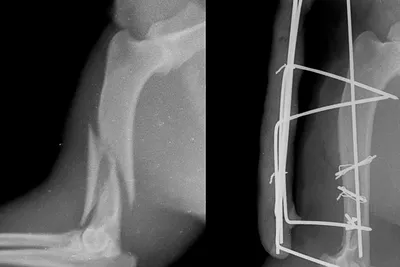 Обзор переломов (Overview of Fractures) - Травмы; отравления - Справочник  MSD Профессиональная версия