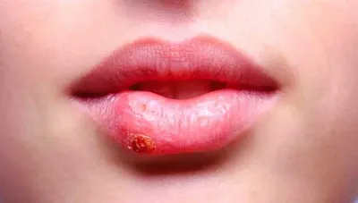 Психосоматика герпеса на губах у женщин: причины, симптомы и лечение