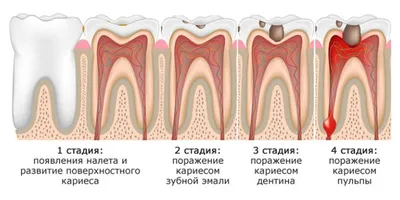 Способы лечения кариеса в стадии пятна