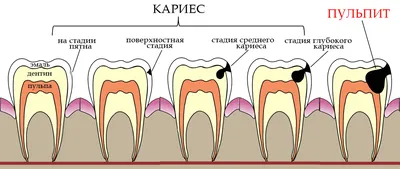 Кариес корня зуба- симптомы, причины, методы лечения кариеса зуба