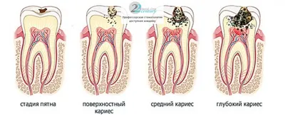 Лечение кариеса в Москве | Стоматология Denta