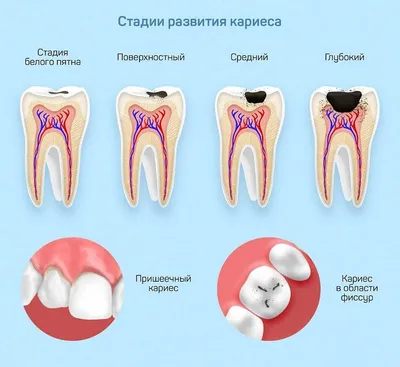 Как развивается кариес