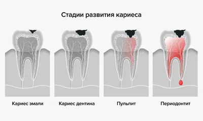 Кариес в стадии пятна