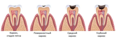 Лечение кариеса - Dental Practice