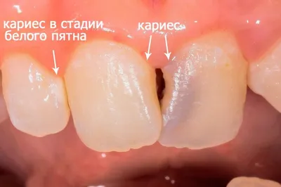 Кариес и методы лечения : стоимость, виды, методы, этапы