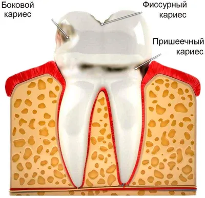 Болезни зубов у человека | статья на сайте Астра Стоматология