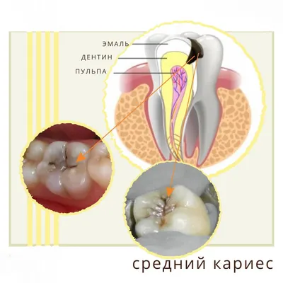 Стадии кариозной инфекции зубов - выявление и лечение