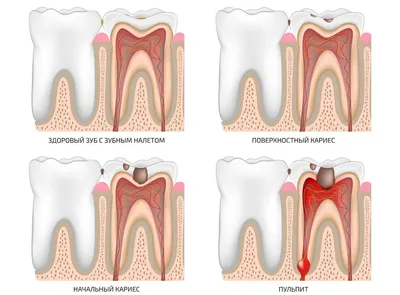 Начальный и поверхностный кариес: симптомы и методы лечения зубов