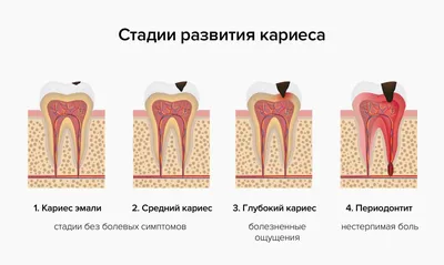 Стадии кариеса: симптомы, причины, методы диагностики | Стоматологическая  клиника «Ваш стоматолог»