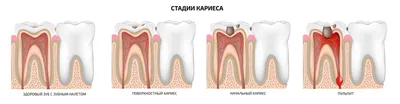 Лечение пришеечного кариеса зуба в Москве ⚡ по цене от от 2100 ₽