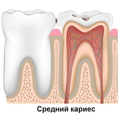 Кариес зубов | Признаки и диагностика кариеса зубов