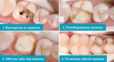 Начальный кариес: причины, лечение – Стоматология «АльфаДент» в Оренбурге