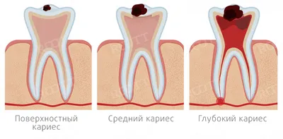 Лечение кариеса в Сургуте