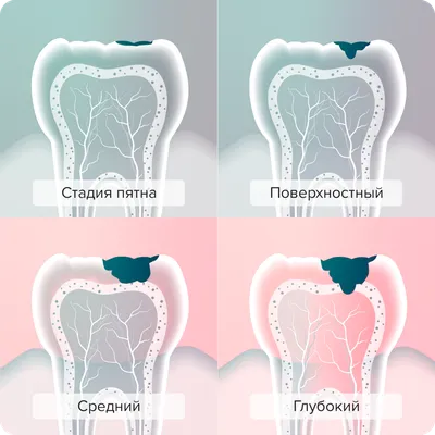 Методы лечения кариеса - детская стоматология \"Рудента\"