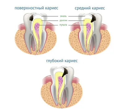 Лечение кариеса в Москве | Стоматология AGILE dental clinic