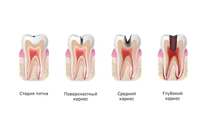 Кариес зуба - причины кариеса зубов, стадии развития и факторы риска