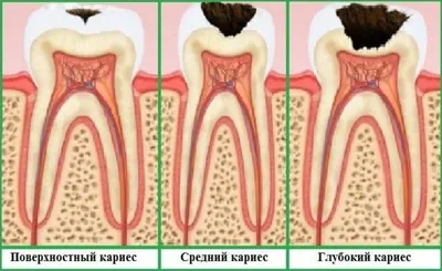 Лечение кариеса