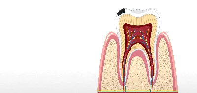 Этапы лечения глубокого кариеса у стоматолога в Перми | Костамед