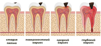 Стадии кариеса