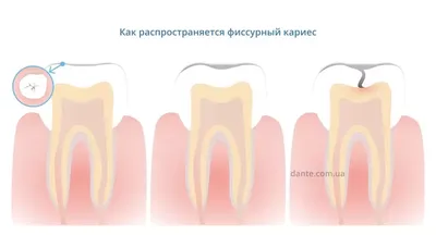 Кариес в стадии пятна — лечение, клиника, диагностика