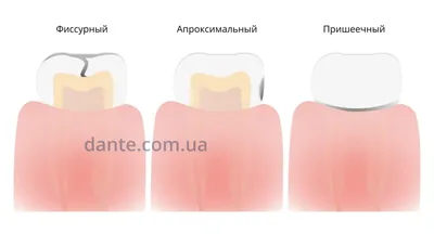 Фиссурный кариес: причины, как лечат и восстанавливают зуб — D.Ante