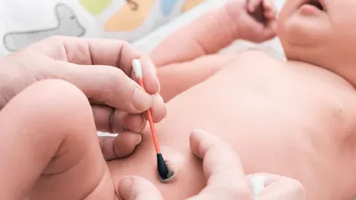 Пупочная ранка у новорожденного: обработка, сколько времени заживает,  почему кровоточит