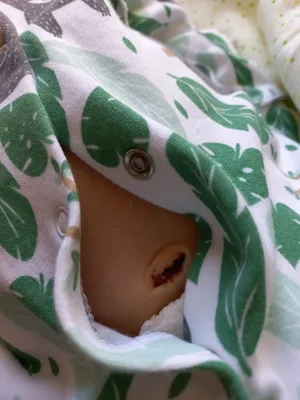 Фунгус пупка у новорожденного ребёнка | Пикабу